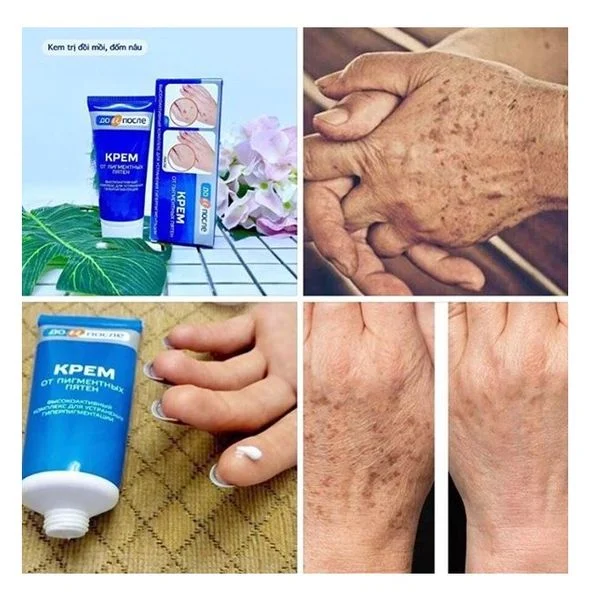 Kem Trị Đồi Mồi Tay Kpem Nga 50ml